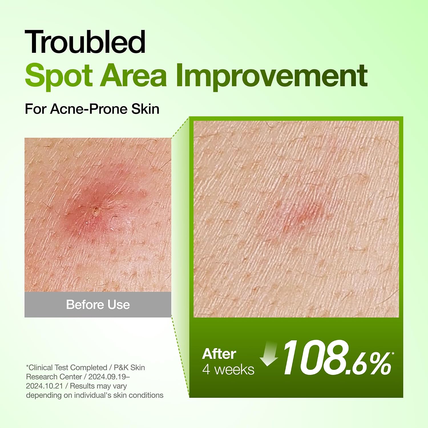 Anua Azelaic Acid 10 Hyaluron Redness Soothing Serum