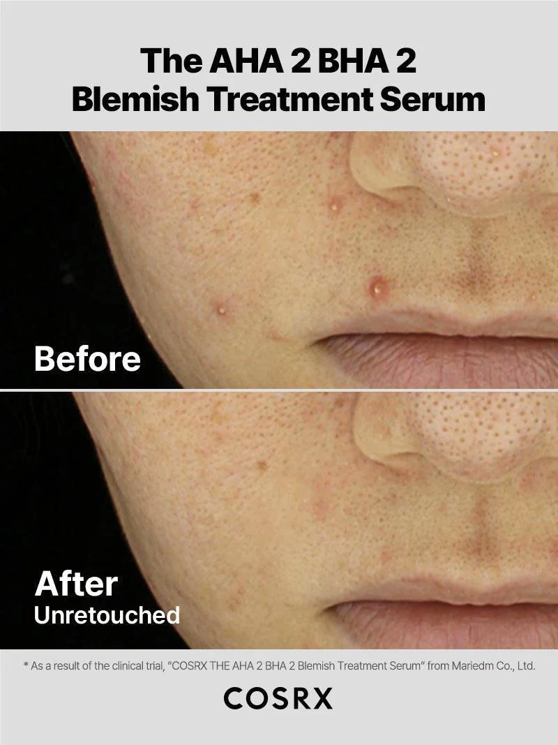 The AHA 2 BHA 2 Blemish Treatment Serum