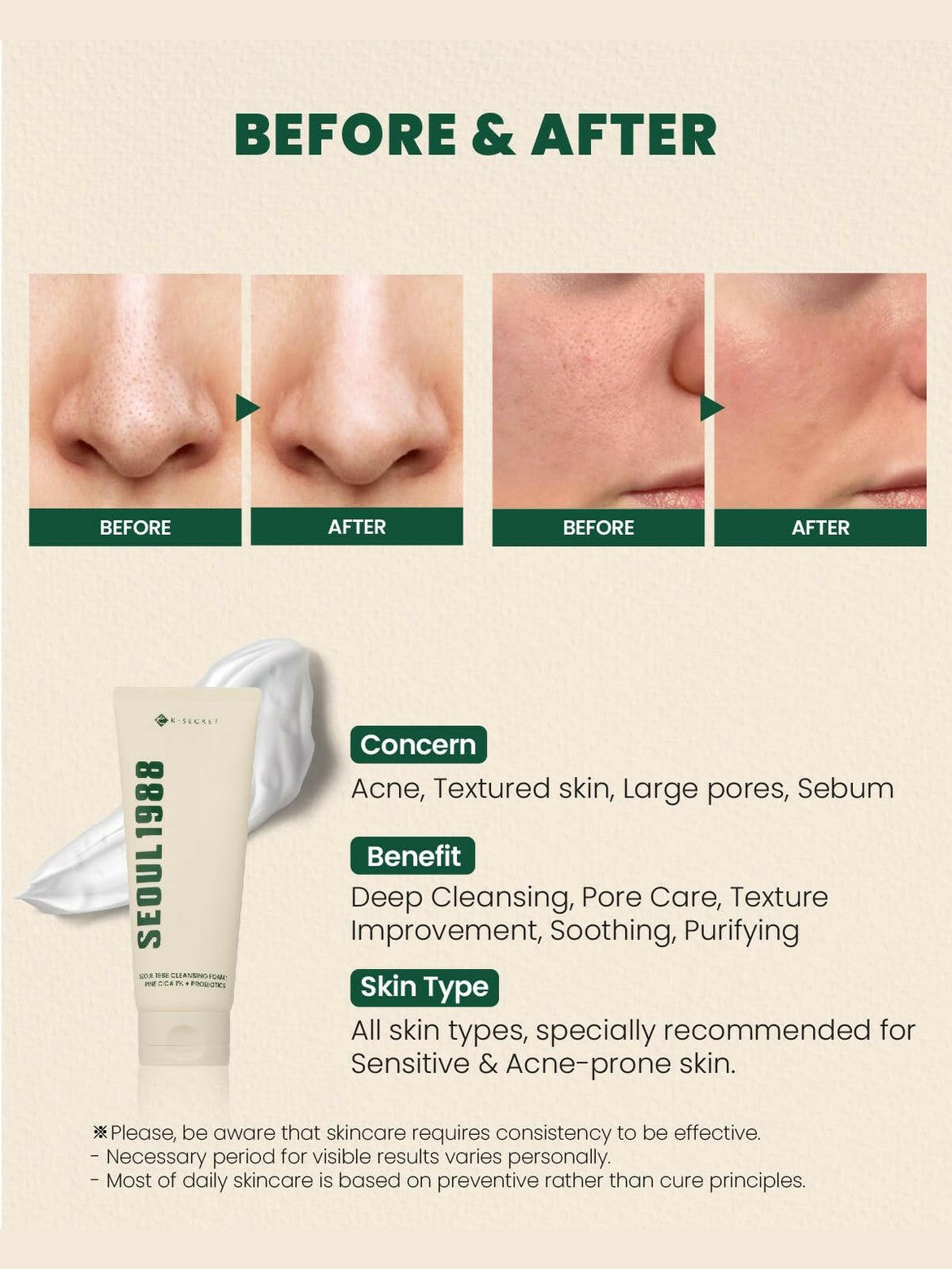 SEOUL 1988 Cleansing Foam : Pine Cica 1% + Probiotics